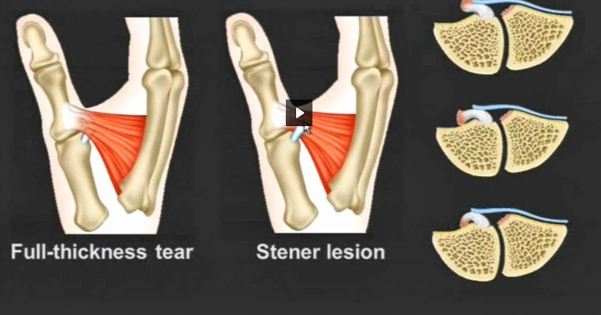 musculoskeletal Gamekeeper's thumb, skier's thumb, Stener's lesion