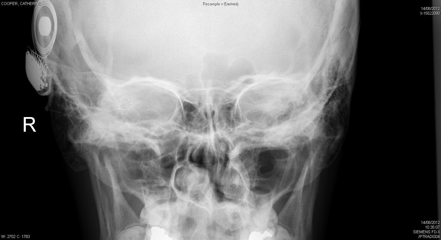 Sounds different Xray of my head