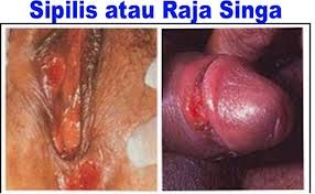 penyakit sipilis atau raja singa penyakit sipilis atau raja singa