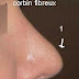 kenacort ( corticoide retard : triamcinolone ) et rhinoplastie