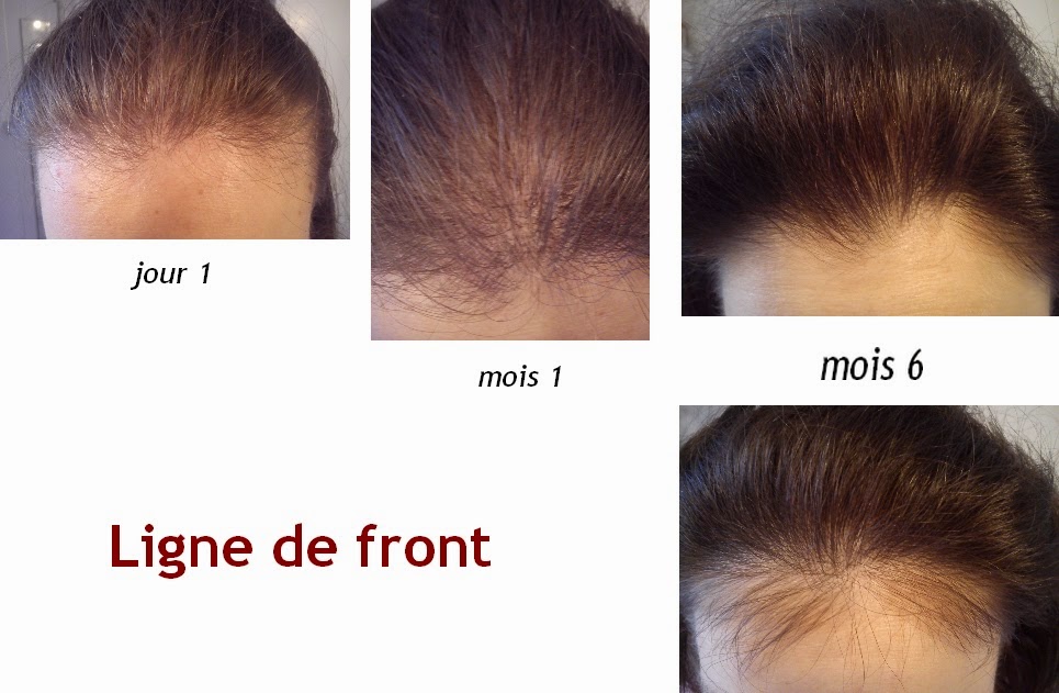 Quel le mieux les vitamines pour les cheveux et les ongles les rappels