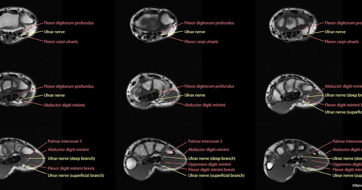 Roentgen Ray Reader: Anatomy of the Volar Branch of the Ulnar Nerve at
