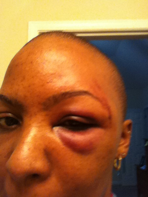 Multiple Sclerosis Facial Swelling Multiple Sclerosis Facial Swelling
