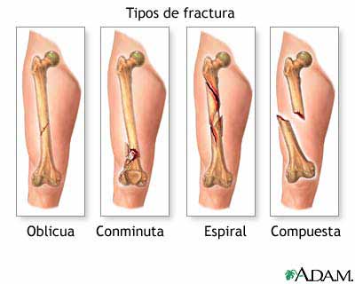 TIPOS DE FRACTURAS