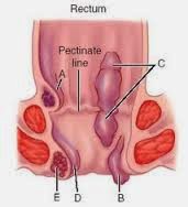 Bagaimana Menyiapkan Rectoscopy Bagaimana Menyiapkan Rectoscopy
