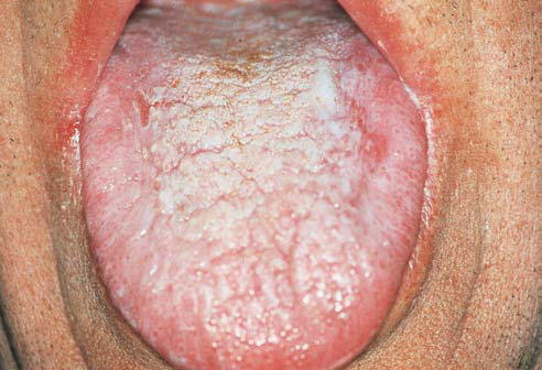 Oral steroid side effects on skin