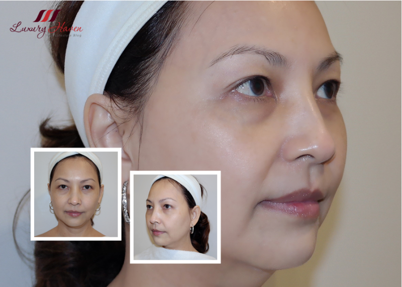 EHA Clinic Take Years Off With Crystal Lift Therapy!