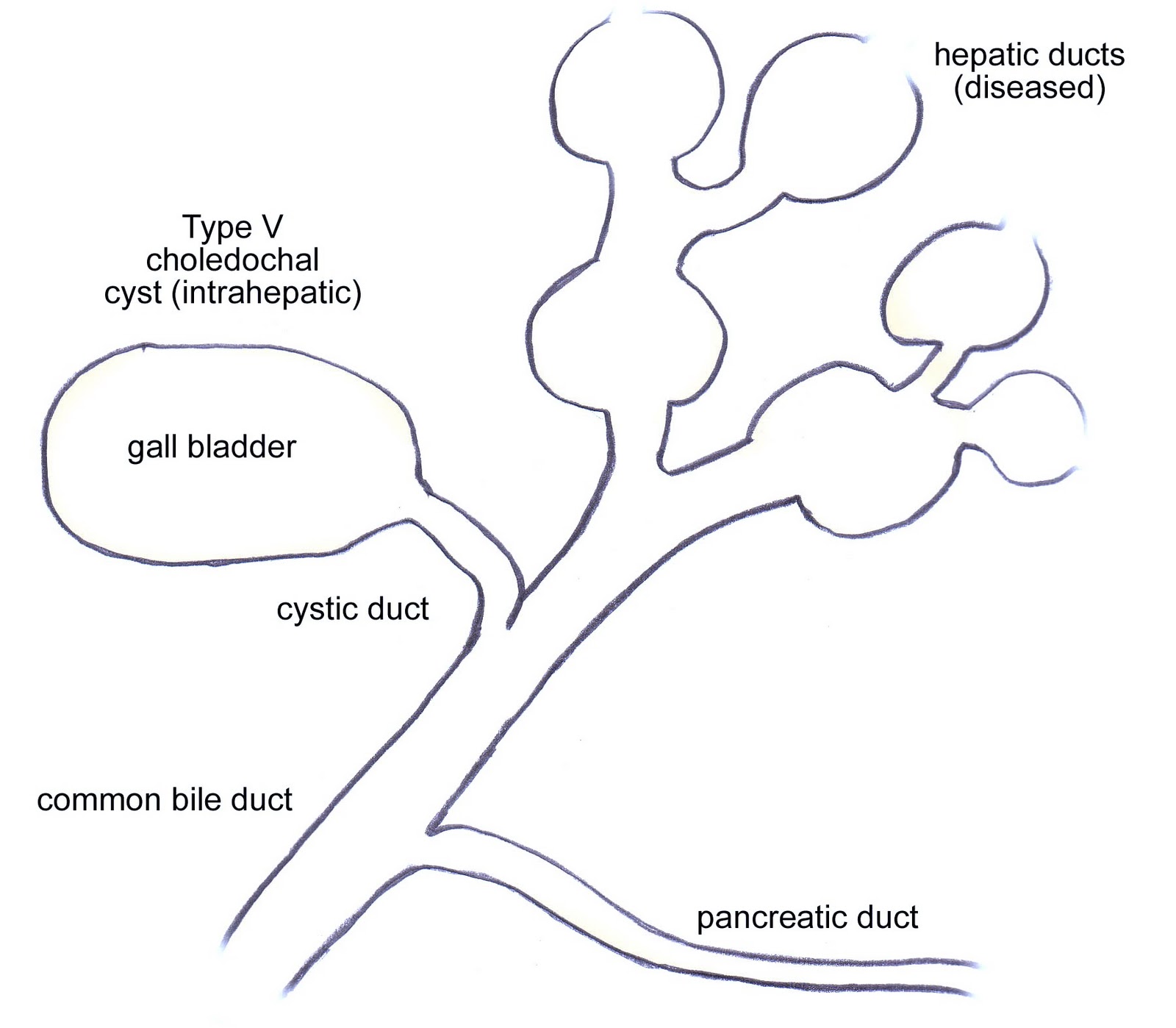 Caroli Disease