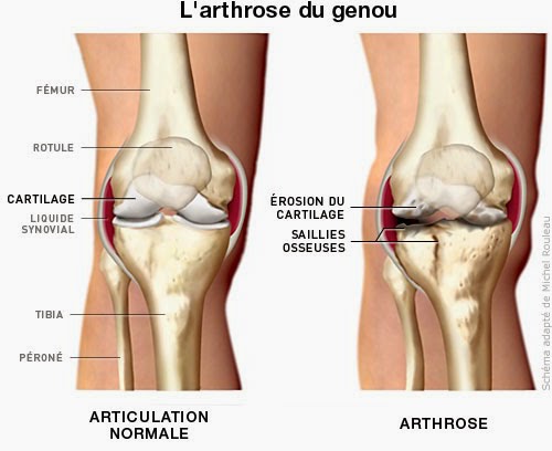 Arthrose du genou : 6.000 pas par jour limite les risques