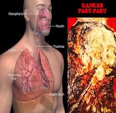 Cara Tuntas Menyembuhkan Penyakit Kanker Paru-Paru Cara Tuntas Menyembuhkan Penyakit Kanker Paru-Paru