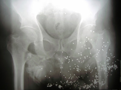 shotgun wound in groin