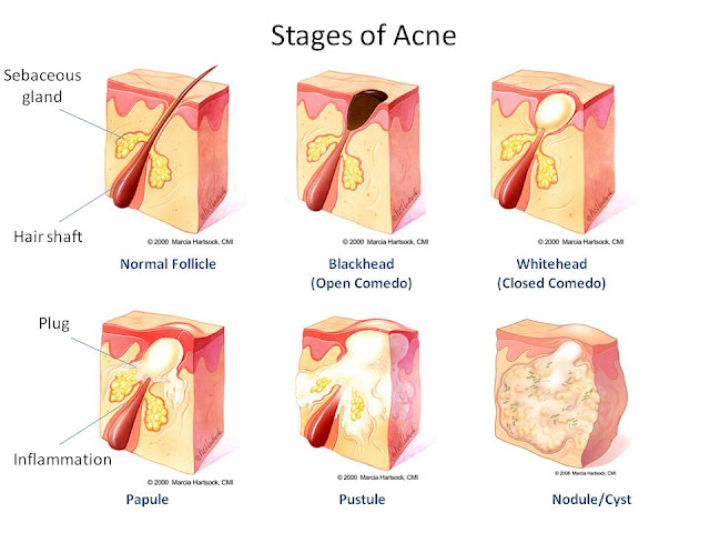 Acne Stages