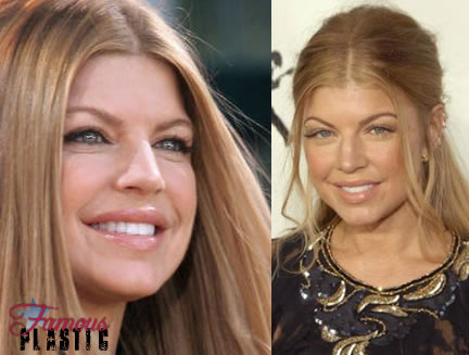 lady gaga before plastic surgery before after. fergie plastic surgery before