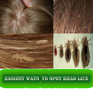 Easiest Ways Reduce and Remove Head Lice