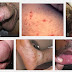 Jual Obat Sipilis Tradisional Untuk Pria thumbnail