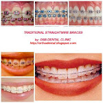 Traditional Straightwire Braces