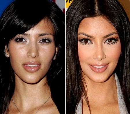 Kim Kardashian Lip Injections 
