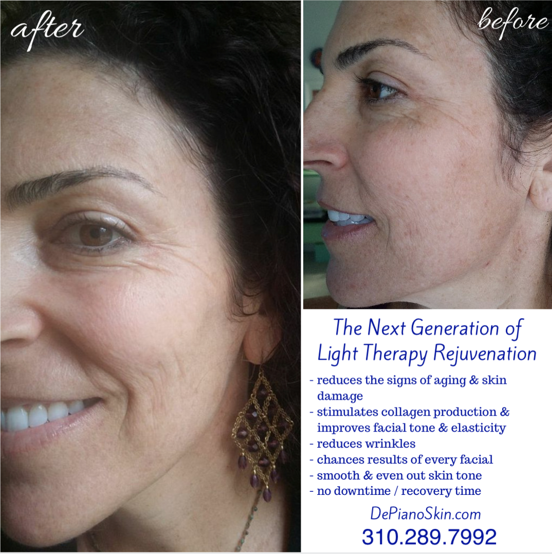 DePiano Skin The Next Generation in Light Therapy Rejuvenation