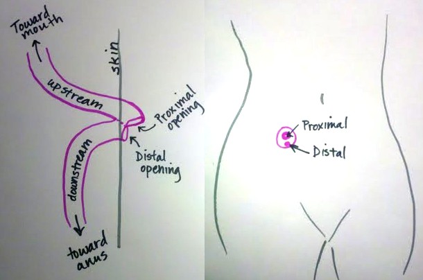 ileostomy diagram fighting for it december 2012 ileostomy diagram fighting for it december 2012