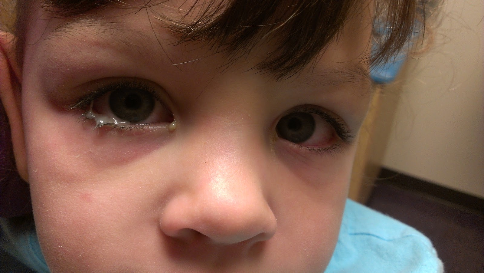 So AMAZINGLY blessed! pink eye, conjunctivitis in our 2 and 5 year olds