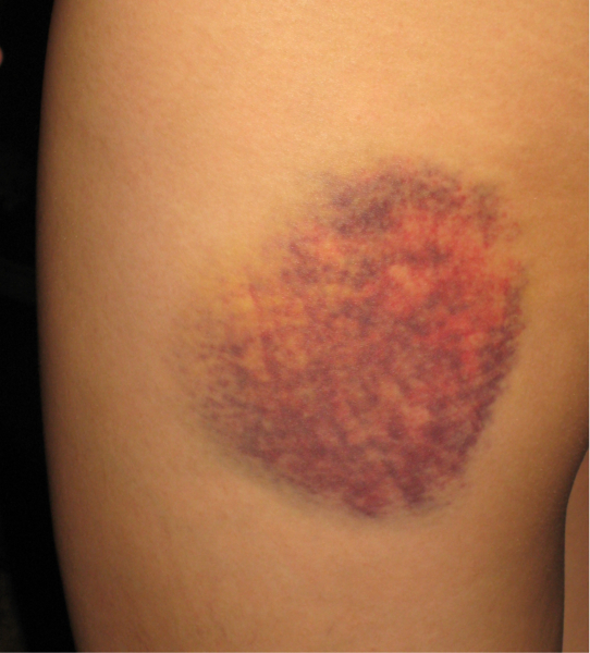 Lump On Calf