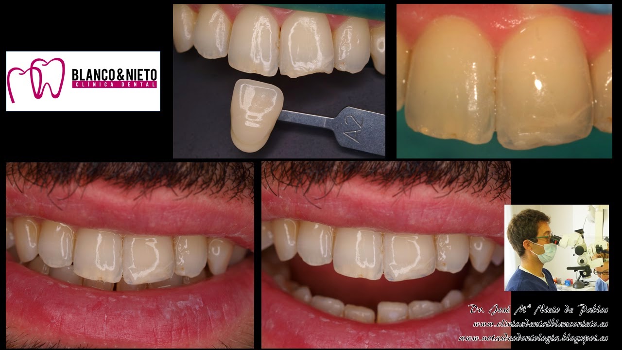 Notas de Odontología Reconstrucción estética del borde incisal de un diente anterior con composites