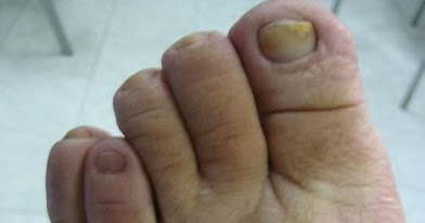 toe short fourth deformities foot