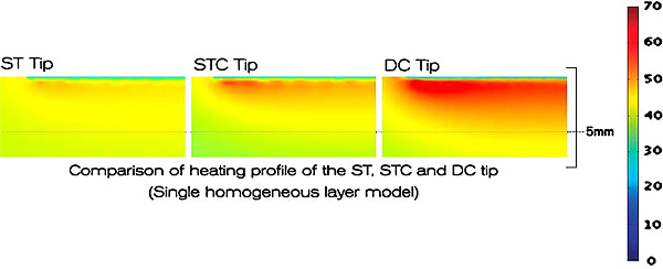 塑顏電波Thermage DC消除臉上肥油 趙彥宇醫師發現利用正確方式塑顏電波Thermage DC可以消除臉上肥油