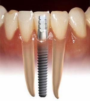 Implant dentaire Problèmes