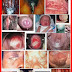 Sedang Mencari Obat AMPUH Gonore, Hub: 085646457211 thumbnail