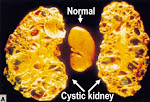 Fighting with Polycystic Kidney Disease