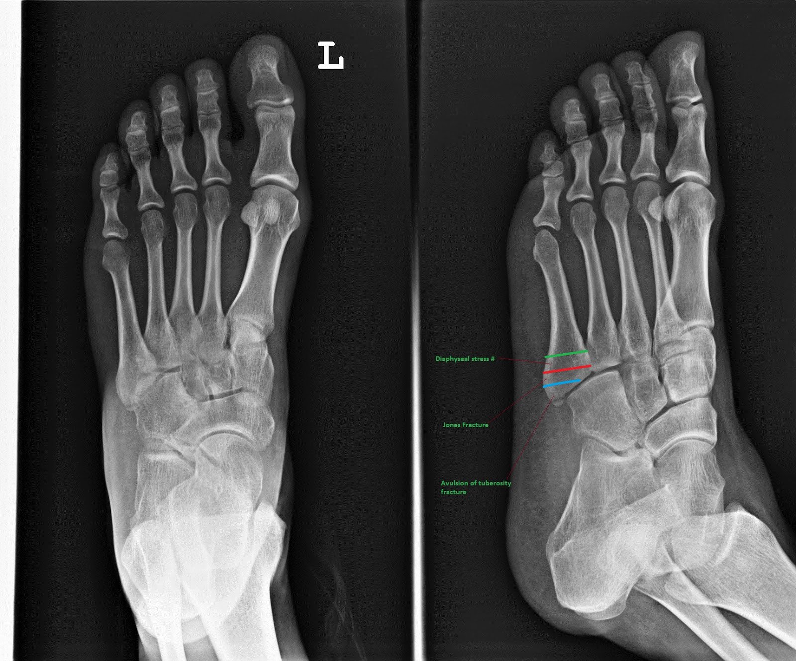 5th metatarsal fracture 5th metatarsal fracture