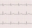 心電図の学習