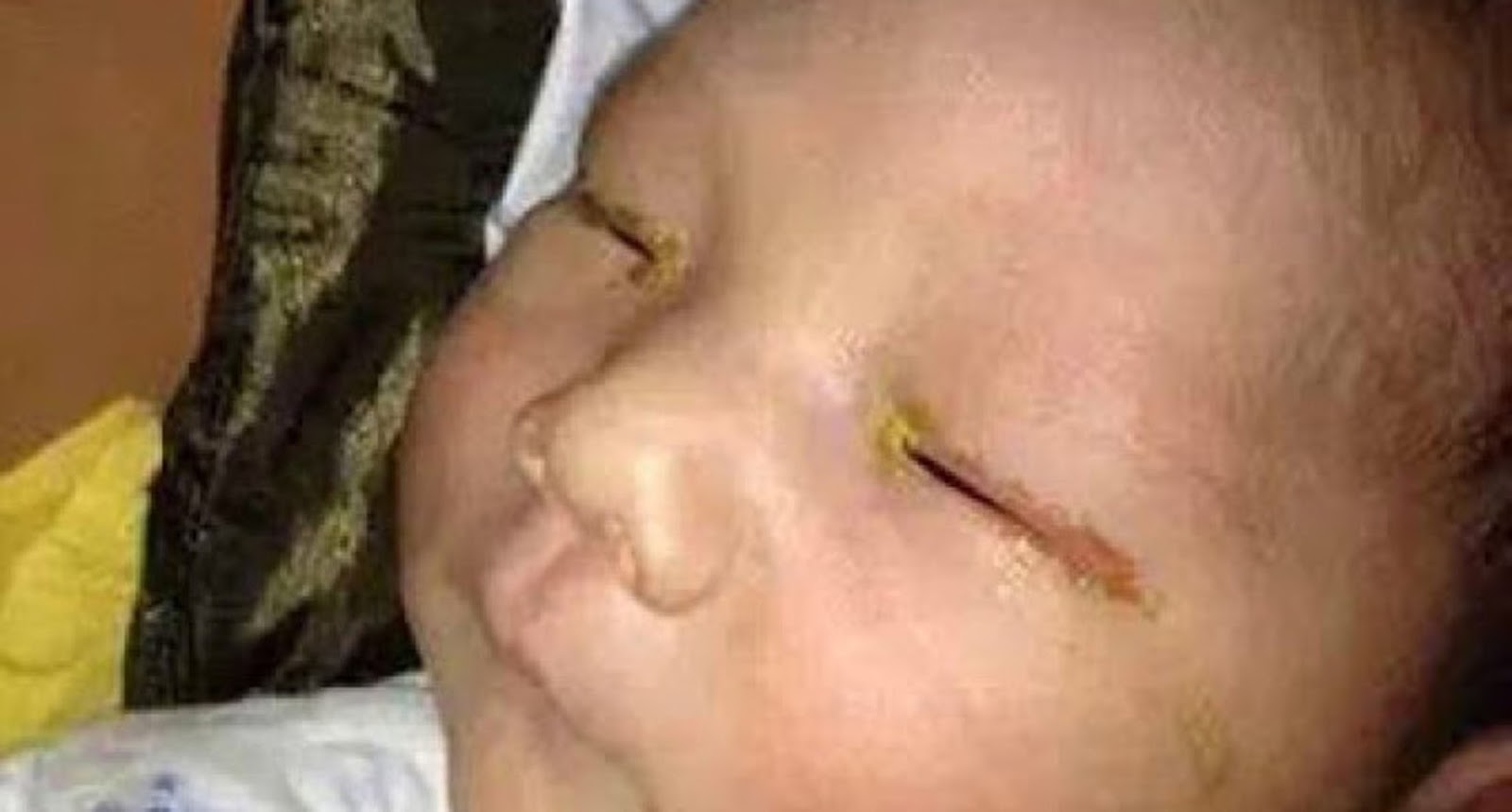 Three month old baby left BLIND in one eye after family friend