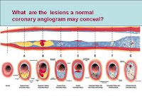 CORONARY ATHEROSCLEROSIS CORONARY ATHEROSCLEROSIS