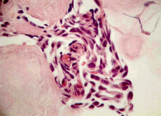 Benign Mesothelioma