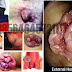 Pengobatan Wasir dengan Ambeclear dan Propolis thumbnail