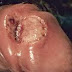 Cara Mengobati Sipilis Dengan Herbal thumbnail