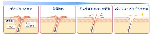 Quá trình điều trị viêm lỗ chân lông của Zaraporo Rohto Nhật Bản