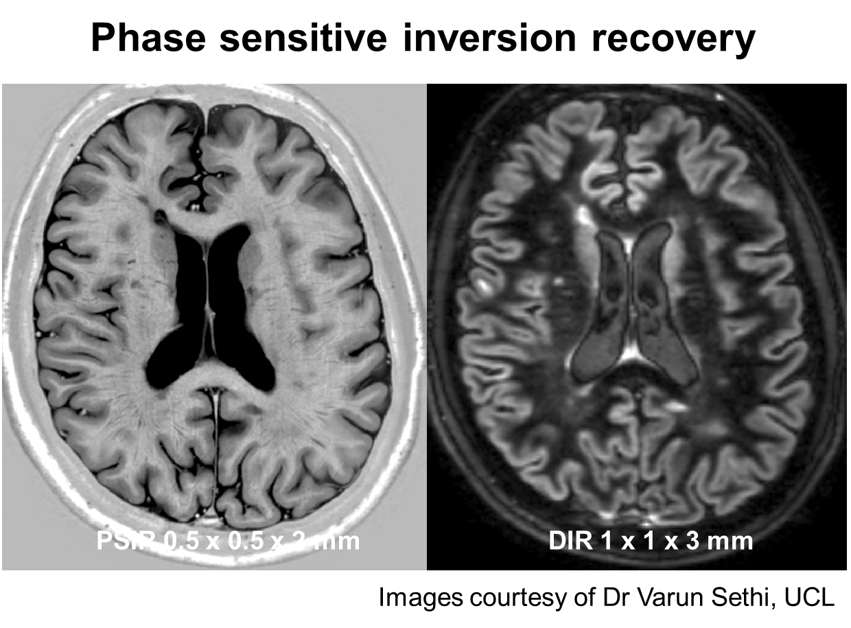 Multiple Sclerosis Research Guest post gray matter lesions in MS