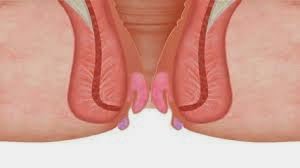 gambar wasir obat wasir setadium 3
