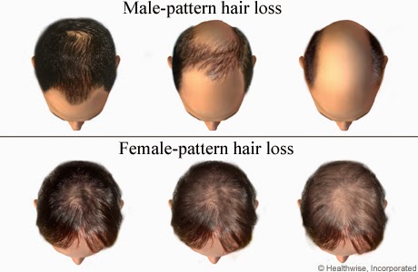 Hair Care Products Anti Hair Loss Treatment Types Of Hair Loss