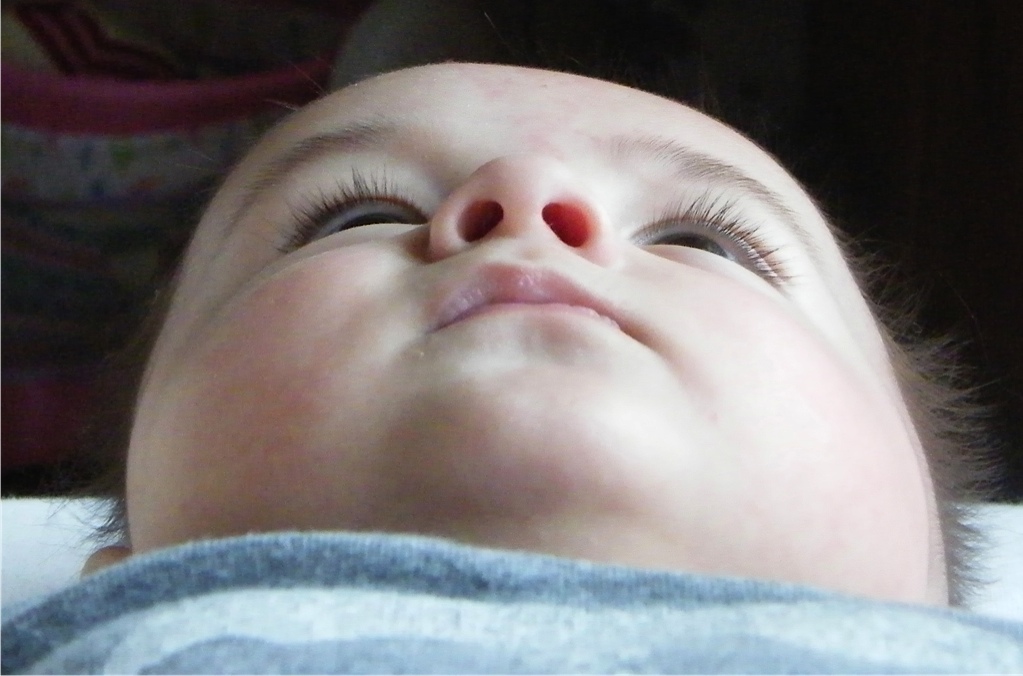 Plagiocephaly Treatment in the UK Evren's Before and After Helmet Photos