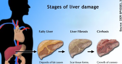 Dangers Of Cirrhosis And Levitra