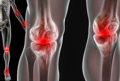 pengapuran sendi lutut osteoarthritis, pengobatan pengapuran sendi lutut pengapuran sendi lutut osteoarthritis, pengobatan pengapuran sendi lutut