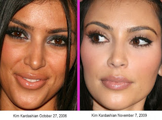 Kim Kardashian Nose Job
