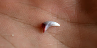 The tooth fell out The tooth fell out