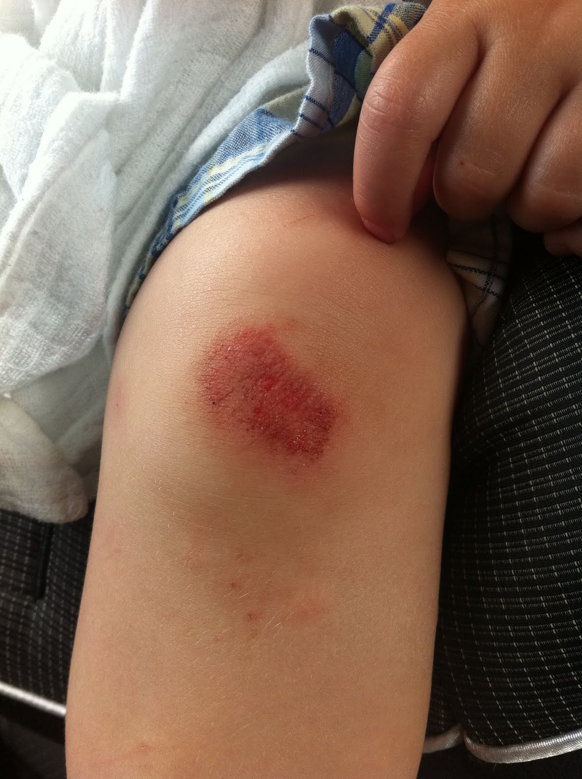 a scraped knee