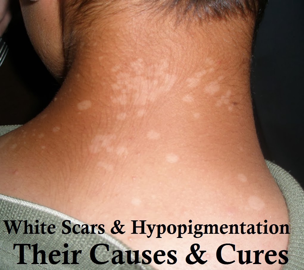 Post Inflammatory Hypopigmentation Natural Treatment Post Inflammatory Hypopigmentation Natural Treatment