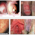Obat Sipilis Manjur De Nature Indonesia